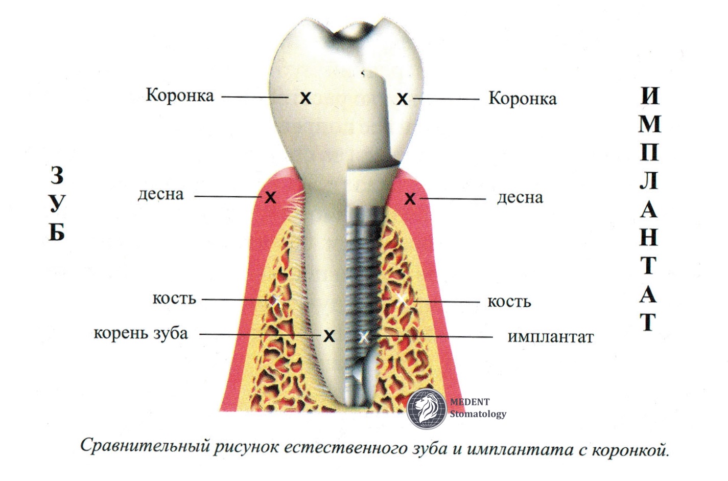 Сравнительный рисунок имплантата с коронкой и естественного зуба