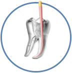 лечение пульпита пульпит зуба лечение удаление нерва эндодонтическое лечение зубов лечение кариеса пульпита цена лечение пульпита стоимость